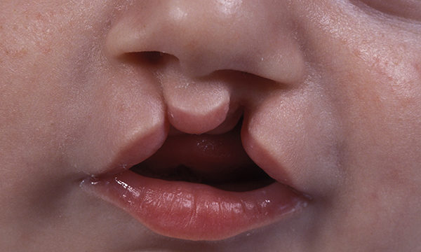 Cleft lip
