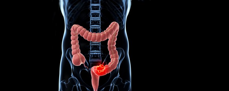 Colorectal Cancer
