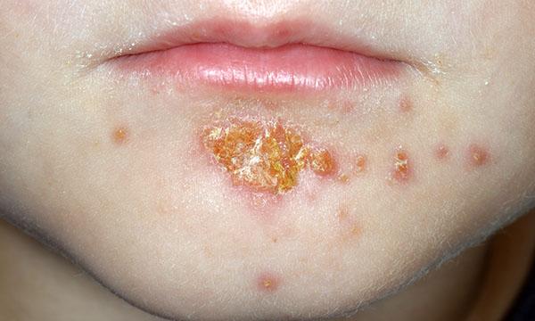 Crust impetigo