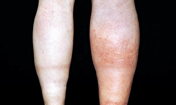 Deep_vein_thrombosis