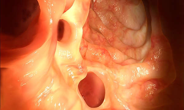 Diverticulitis