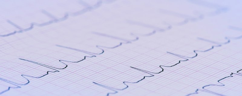 Electrocardiogram