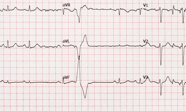 ECG