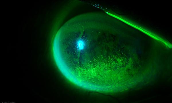 How to care for a patient's eyes in critical care settings