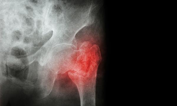 Hip Fracture_tile_iStock.jpg