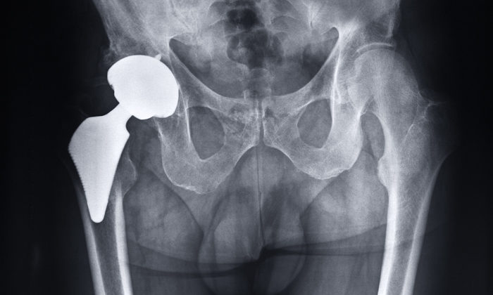 hip replacement