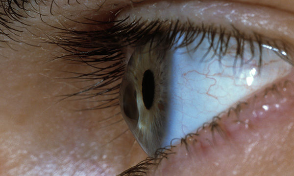 Keratoconus