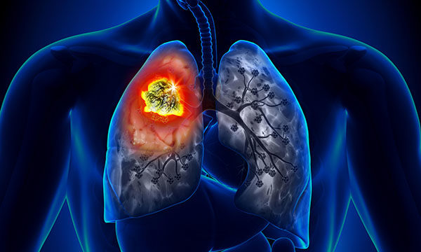 lung cancer