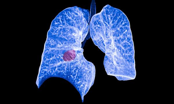Lung Cancer