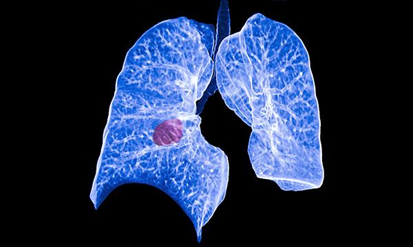 Lung cancer