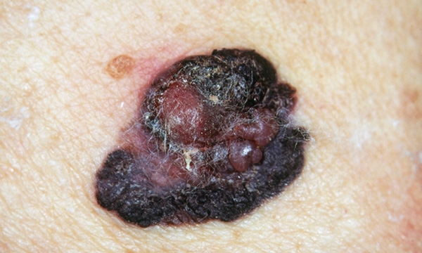 Malignant melanoma