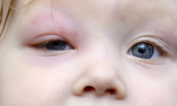 Orbital Cellulitis
