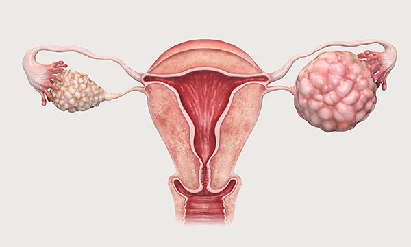 Ovarian cancer
