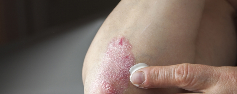 Psoriasis