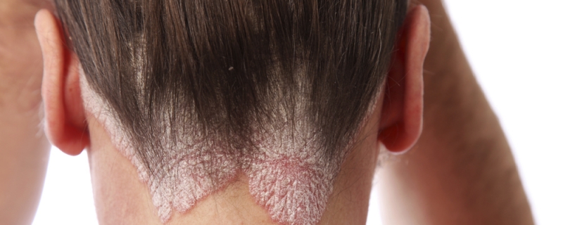 Scalp psoriasis
