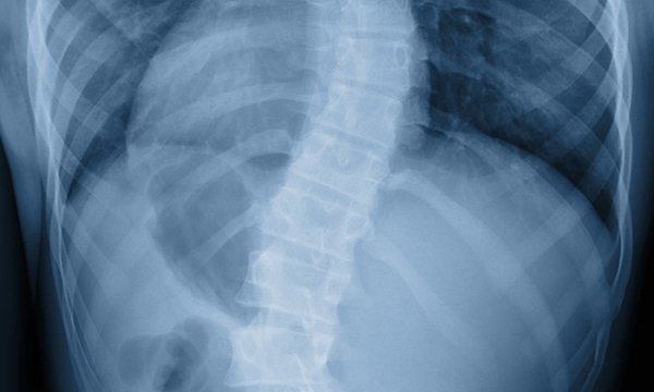 Scoliosis