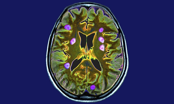Secondary breast cancer