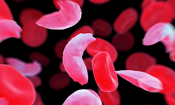 Sickle cell