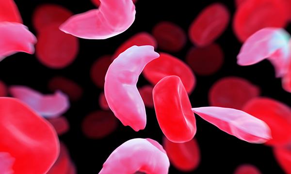 Sickle-cell disease