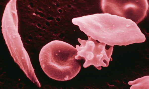 Sickle cell 