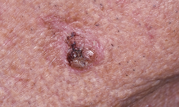 Squamous cell carcinoma