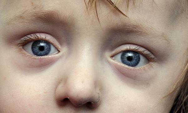 Sclera caused by brittle bone disease