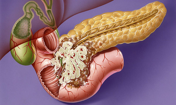 Supportive care needs of people with pancreatic cancer: a literature review