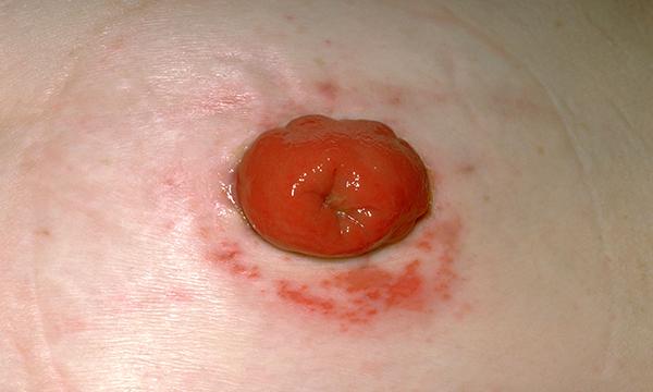 Colostomy stoma