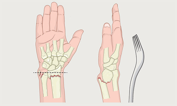 Colles’ fractures in emergency departments