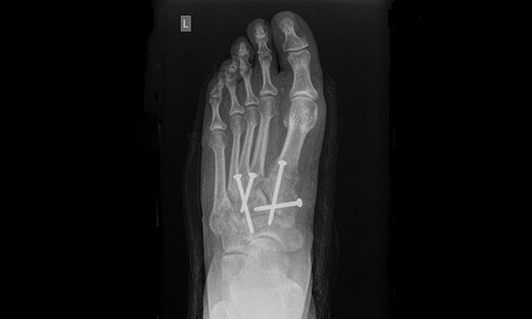 Lisfranc injury