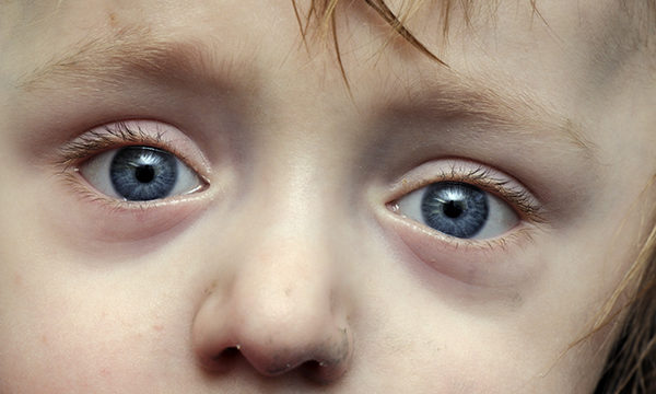 Osteogenesis imperfecta (OI)