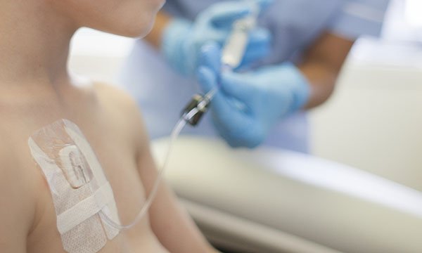 Care and management of children with a totally implanted central venous access device: portacath