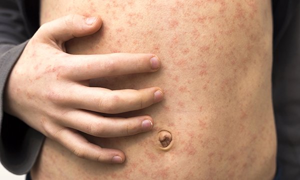 Understanding measles infection and how to improve uptake of the MMR vaccine