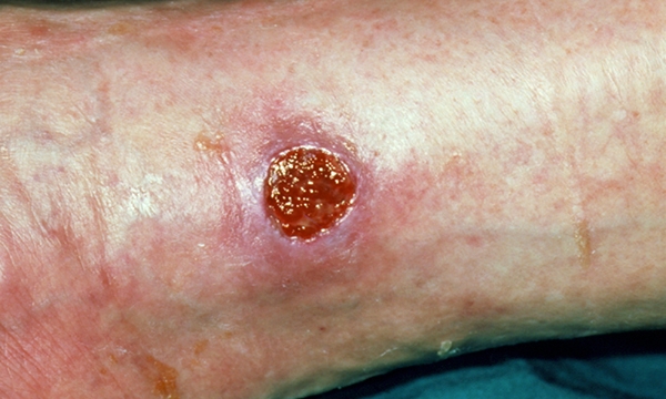 Assessment and management of older people with venous leg ulcers