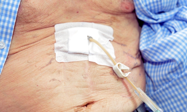 Providing nutritional support for patients in critical care