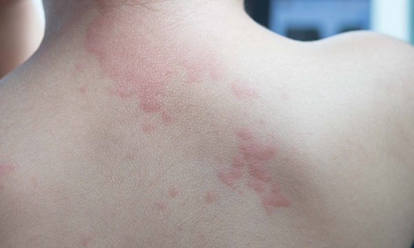 Managing chronic spontaneous urticaria (hives) in primary care