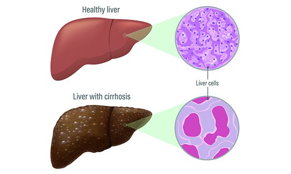 Preventing, identifying and treating hepatitis C