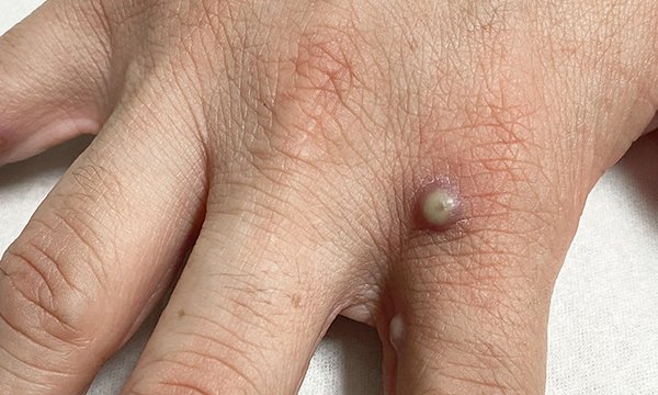 Mpox: exploring the nursing role in diagnosis, management and controlling its spread